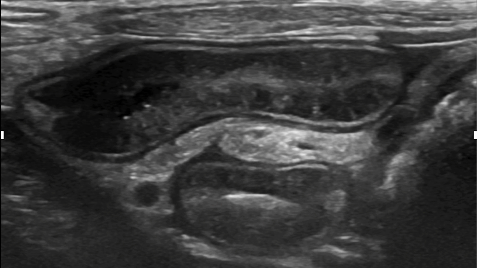 腸炎の長期的な見通し